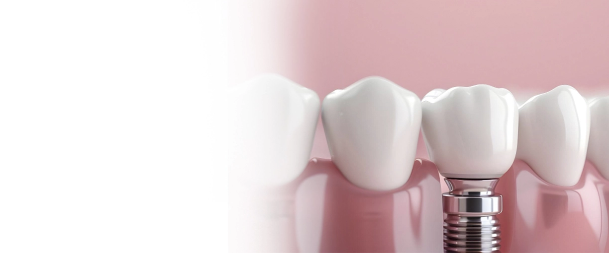 Доступная имплантация зубов